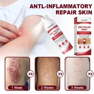 𝗟𝘂𝘅𝗮𝗿𝗶𝘀𝒆® 𝗕𝗲𝗲𝗳 𝗧𝗮𝗹𝗹𝗼𝘄 𝗦𝗽𝗿𝗮𝘆 𝗳𝗼𝗿 𝗜𝘁𝗰𝗵𝘆, 𝗙𝗹𝗮𝗸𝘆 𝗣𝘀𝗼𝗿𝗶𝗮𝘀𝗶𝘀 𝗦𝗸𝗶𝗻