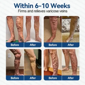 Alisanda® 𝑽𝗲𝗶𝙣 𝘾𝐨𝐧𝘁𝗼𝙪𝙧 𝙈𝙞𝐜𝐫𝒐𝒏𝒆𝗲𝗱𝗹𝙚 𝙋𝙖𝐭𝐜𝒉 𝒘𝒊𝘁𝗵 𝗔𝙙𝙫𝙖𝙣𝙘𝐞𝐝 𝐃𝒊𝒐𝒔𝗺𝙞𝐧 & 𝑯𝒆𝘀𝗽𝗲𝙧𝙞𝙙𝙞𝐧 𝐃𝒆𝒍𝒊𝒗𝗲𝗿𝙮🌿𝟕-𝐃𝐚𝐲 𝐕𝐢𝐬𝐢𝐛𝐥𝐞 𝐑𝐞𝐬𝐮𝐥𝐭𝐬 𝐟𝐨𝐫 𝐕𝐚𝐫𝐢𝐜𝐨𝐬𝐞 𝐕𝐞𝐢𝐧𝐬 — 𝗔𝗱𝘃𝗮𝗻𝗰𝗲𝗱 𝗛𝗲𝗿𝗯𝗮𝗹 𝗕𝗹𝗲𝗻𝗱 𝗧𝗮𝗿𝗴𝗲𝘁𝘀 𝗦𝗽𝗶𝗱𝗲𝗿 𝗩𝗲𝗶𝗻𝘀 & 𝗥𝗲𝗹𝗶𝗲𝘃𝗲𝘀 𝗛𝗲𝗮𝘃𝘆, 𝗧𝗶𝗿𝗲𝗱 𝗟𝗲𝗴𝘀