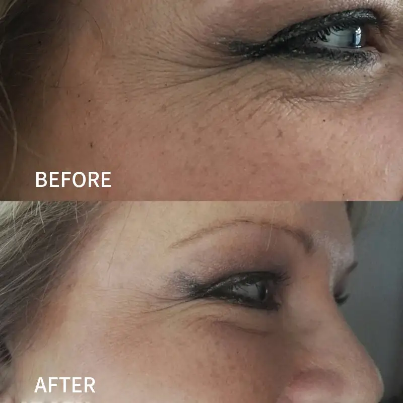 Newyuo™ Anti-Wrinkle Face Tape for Frown Lines, Crow’s Feet & Smile Lines, 110 Pre-Cut Strips