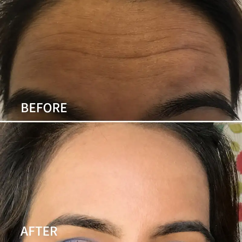 Newyuo™ Anti-Wrinkle Face Tape for Frown Lines, Crow’s Feet & Smile Lines, 110 Pre-Cut Strips